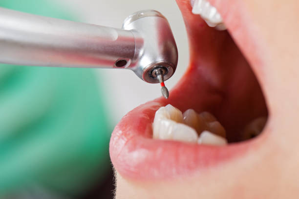 Best Dental Abscess Treatment in Strathmore, CA